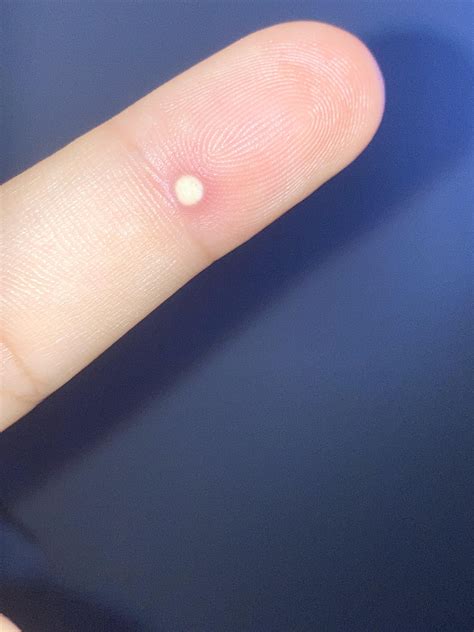 Bump on index finger : r/scleroderma