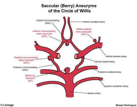 Aneurysms - Neurology - Medbullets Step 1