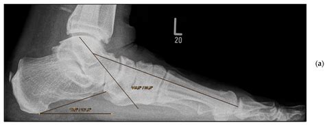Adult-Acquired Flatfoot Deformity: Combined Talonavicular Arthrodesis ...