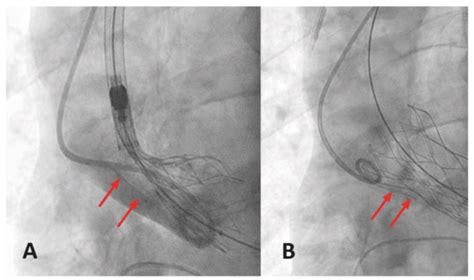 JCM | Special Issue : Transcatheter Structural Heart Disease ...