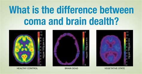 What is the Difference Between a Coma and Brain Death? | LifeSource