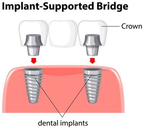 Dental Implant Bridge Cost