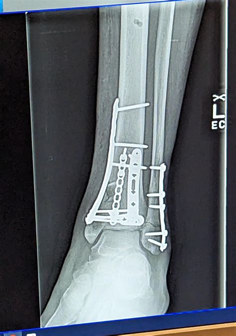 Compound fracture of tib/fib : r/Radiology