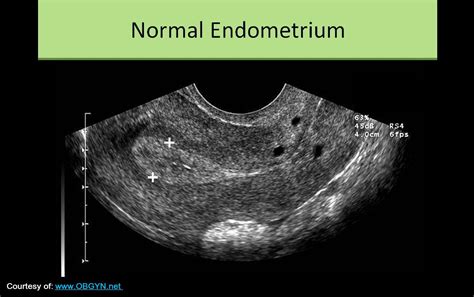 Secretory Phase Endometrium Ultrasound Full Article: Transvaginal