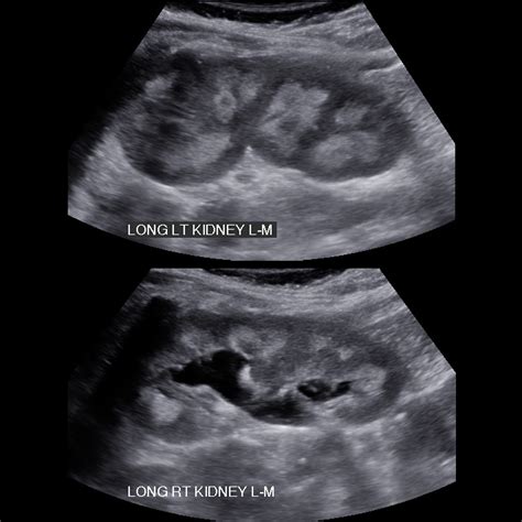 Nephrokalzinose | pacs