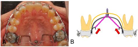 Open-Bite Correction Using a Mid-Palatal TAD with an Intrusion TPA ...