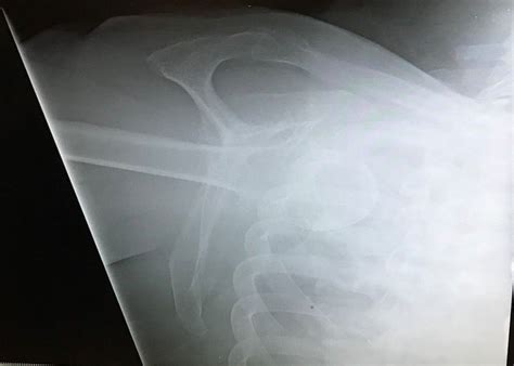 Image:Inferior Shoulder Dislocation-MSD Manual Professional Edition