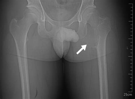 Aggressive lytic lesion of lesser trochanter proximal femur in an ...