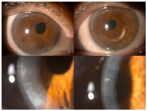 Posterior Polymorphous Corneal Dystrophy in a Patient with a Novel ZEB1 Gene Mutation