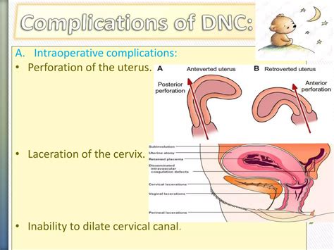 Introduction,dilataion and curretage&suction curetage | PPTX
