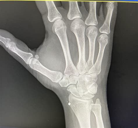 41 yo F c/o wrist pain. Wrist X-ray 16 days post falling on stretched arm from moving bike ...