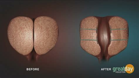 Texas Urology Specialists offer Urolift treatment for enlarged prostate ...