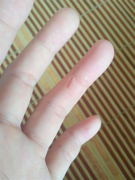 今天被自己家狗狗咬伤手指。破皮了，出血。我用肥皂洗了洗，然后用酒精一直冲洗伤口，，还用不用去打针。_百度知道