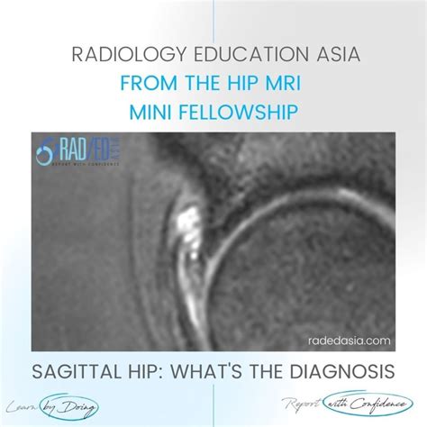 HIP PARALABRAL CYST MRI LABRUM TEAR DEGENERATION - Radedasia