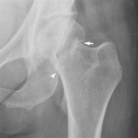 Impacted Fracture Femur