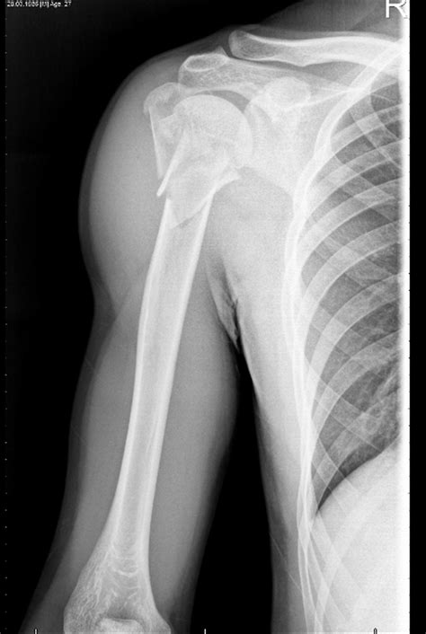 Proximal Humerus Fractures - Trauma - Orthobullets.com