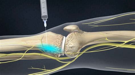 Genicular Nerve Block Des Moines, Iowa | G Block Injection