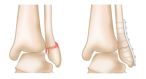 Ankle Fractures (Broken Ankle) - OrthoInfo - AAOS
