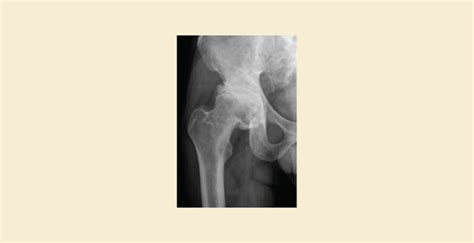 Avascular Necrosis and Osteoarthritis | Understand The Differences! – Knya