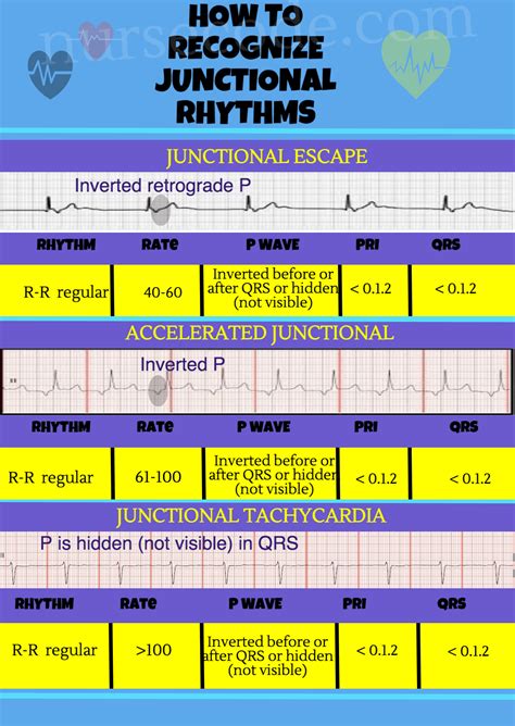 Junctional Rhythm InfoGraphic | Heartbeat | Cardiac nursing, Icu ...