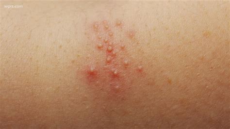 Case of measles in Erie County | wgrz.com