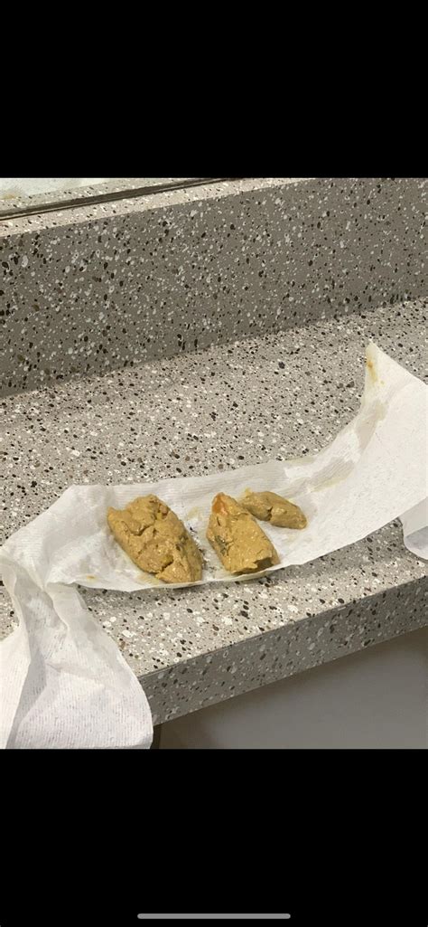 Is this considered pale/clay stools?? Can it be lack of bile issues?? Plz help , its been few ...