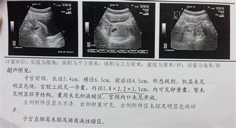 40天，看不到孕囊怎么回事？孕早期孕囊大小与怀孕时间对照表_胎儿