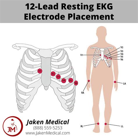 Stress Test Ecg Lead Placement at Elmer Michael blog
