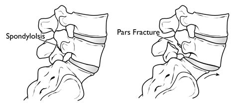 Kuvatulokset haulle pars fracture treatment