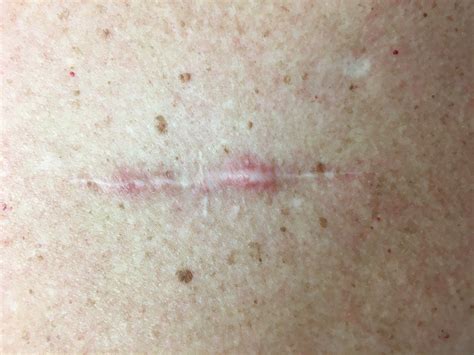 Keloid Icd 10 Therapie Pathologischer Narben (hypertrophe Narben Und