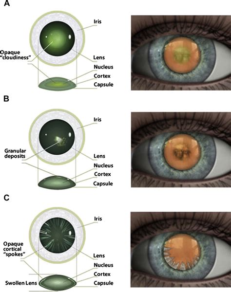 Cataracts - Primary Care: Clinics in Office Practice