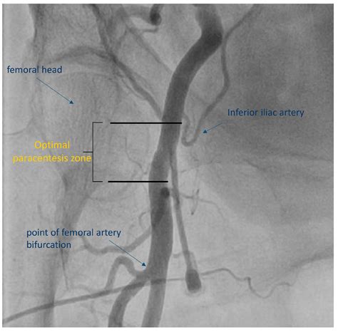 Femoral Pulse Landmark