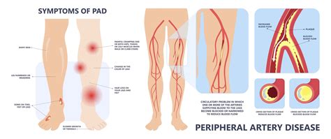 Peripheral Artery Disease: Symptoms, Treatments, And Causes – Netzdot