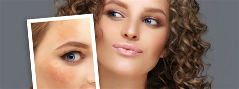 How to Reduce Melanin: A Complete Step Guide – World of Asaya