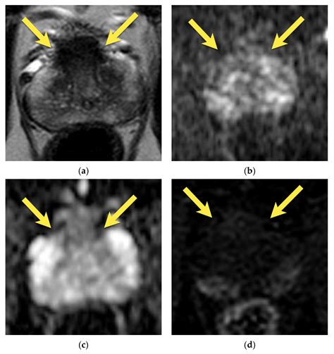 Prostate Gland Anatomy Mri
