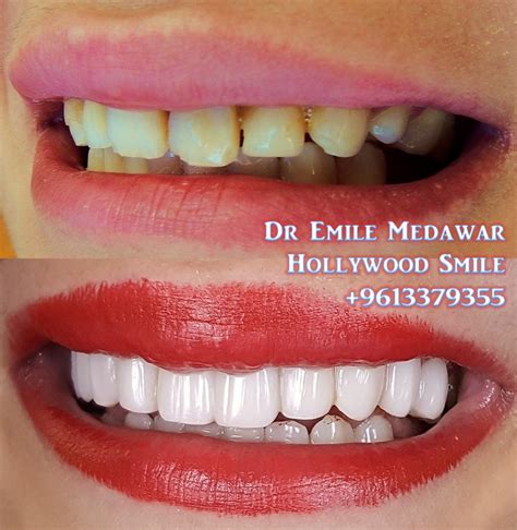 Composite Veneers 1 | Composite Veneers Lebanon