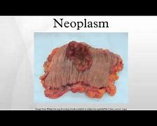 Image result for Neoplasm