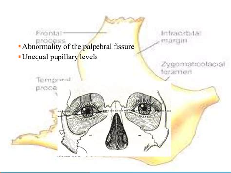 Management of zygomaticomaxillary complex fractures ih | PPTX