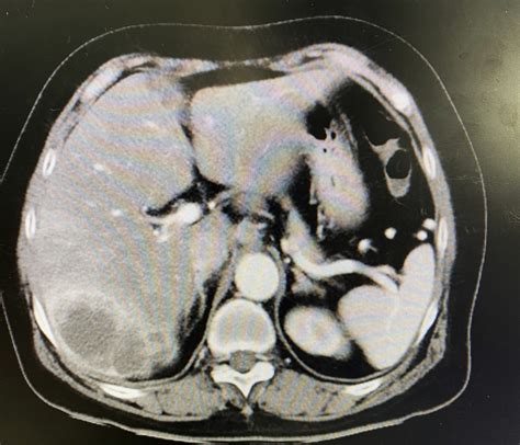 Cholangiocarcinoma: the bile duct cancer with a low survival rate