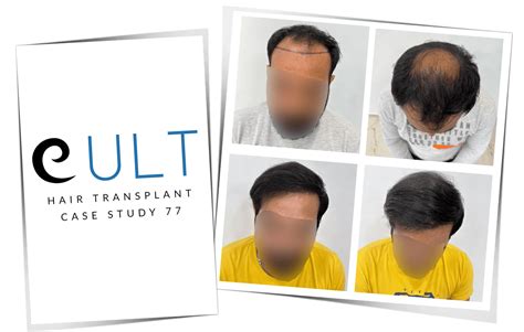 Hair Transplant Case Study 77 | Cult Aesthetics