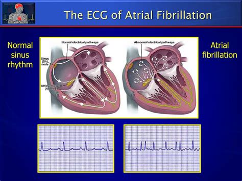 Atrial Fibrillation 的图像结果
