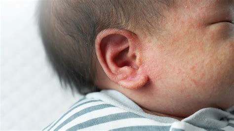 Ear Eczema: Causes, Symptoms, and Treatments - GoodRx
