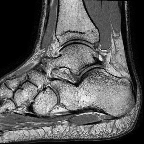 What Does A Normal Foot X Ray Look Like at Charli Light blog