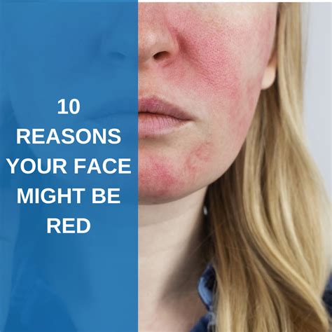 Why Is My Face Red