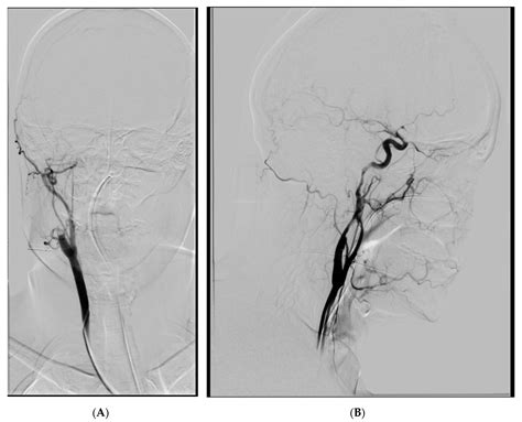 Endovascular Treatment of Stroke Caused by Carotid Artery Dissection