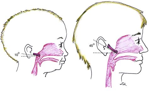 Pediatric Otitis Media - Physician Assistant Clinics - length of eustachian tube