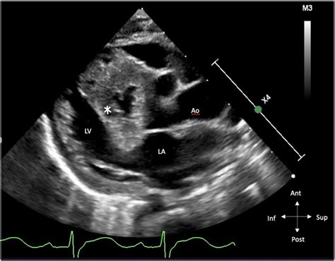 A Rare Case of Tricuspid Atresia Absent Pulmonary Valve Diagnosed on Fetal Echocardiography - CASE