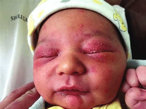 Baby Rash On Face Swollen Eye at Cecil Powell blog