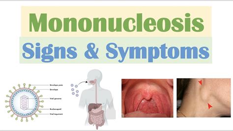 What Are The Warning Signs Of Mononucleosis at Dolores Robertson blog