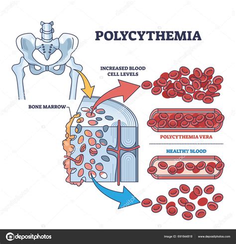 Polycythemia Vera Blood Cancer Type Increased Red Cells Outline Diagram Stock Vector by ...